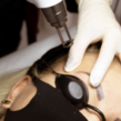 Curs de Indepartare a tatuajelor