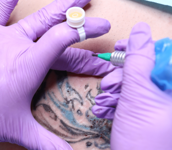 Curs Tattoo Removal