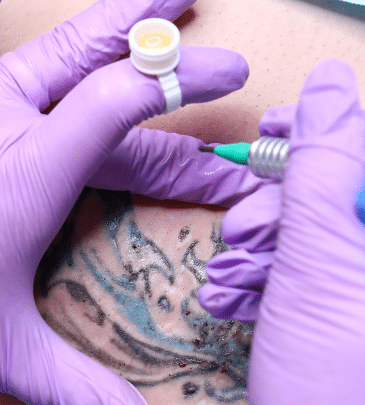 Curs Tattoo Removal