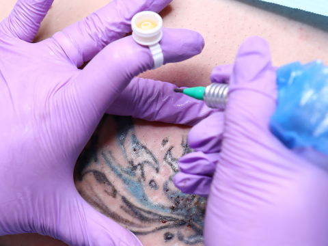 Curs Tattoo Removal