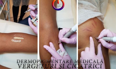 Dermopigmentare Medicală – Vergeturi și Cicatrici
