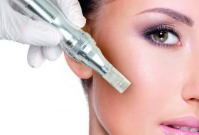 Mezoterapia cu microneedling (microace)