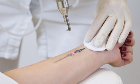 Ce trebuie sa stii despre indepartarea tatuajelor prin tehnologia LASER