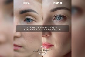 Plasma Pen- inovatia tratamentelor cosmetice