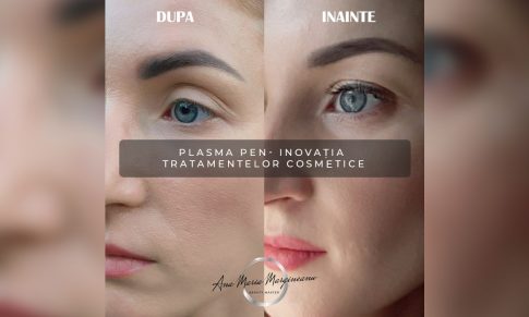 Plasma Pen- inovatia tratamentelor cosmetice