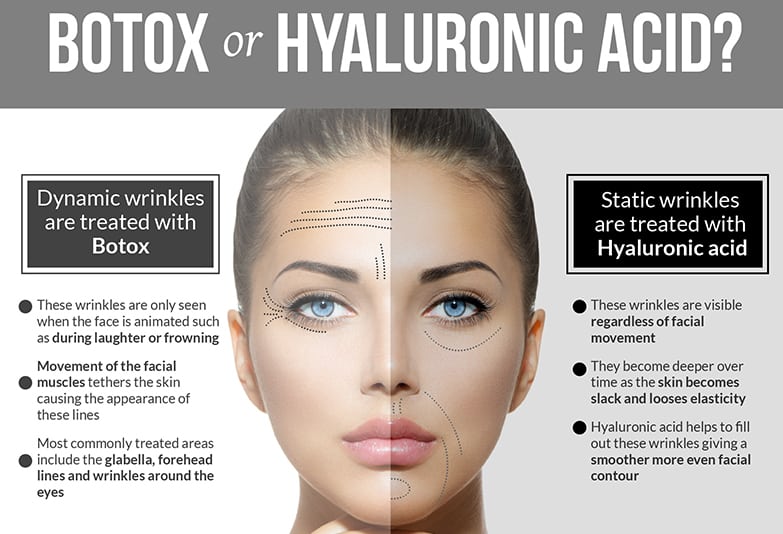 botox sau acid hialuronic pentru buze